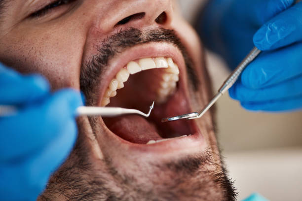Best Dentist for Tooth Abscess  in Rotan, TX